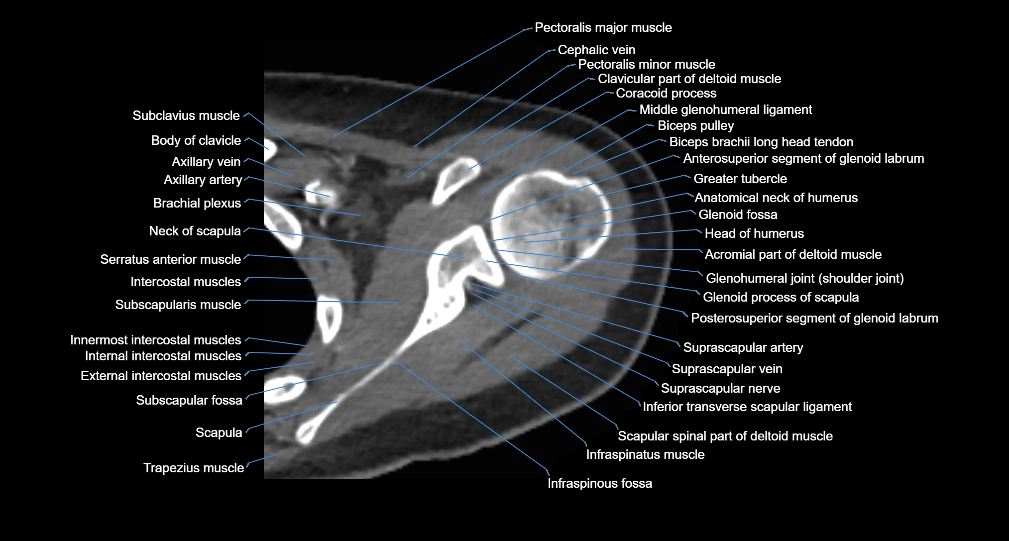 CT Shoulder axial cross sectional anatomy labelled radiology image -00028.webp